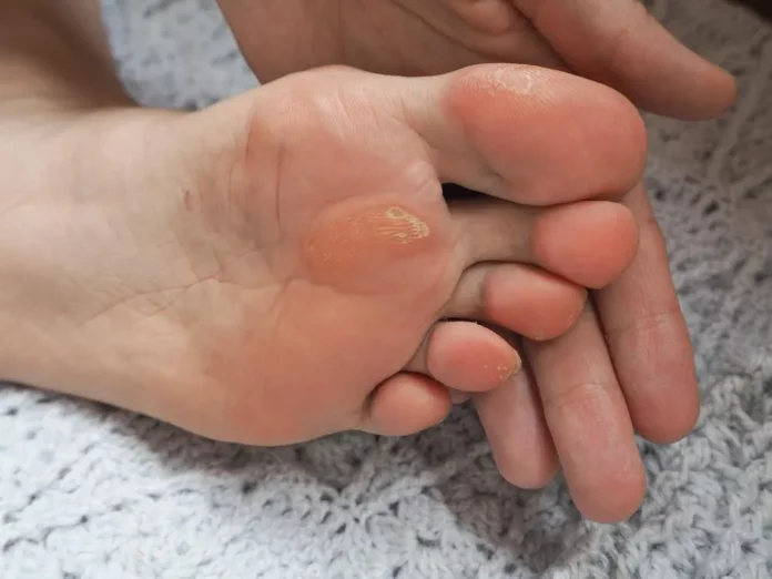 How to get rid of calluses on feet
